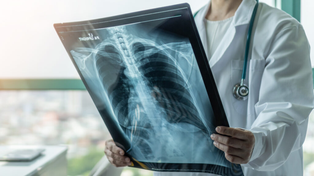 médico a examinar raio x de um pulmão